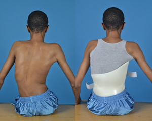 Comparison showing scoliosis treatment with bracing